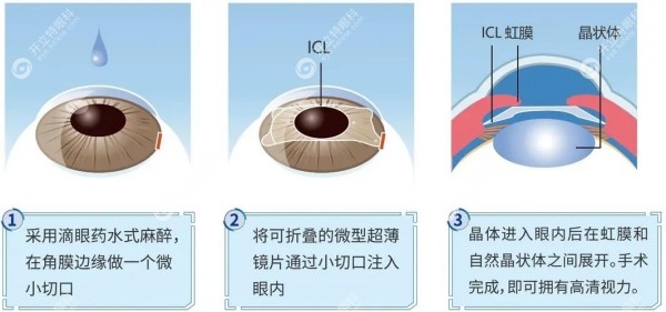 熊瑛做icl晶体植入手术怎么样