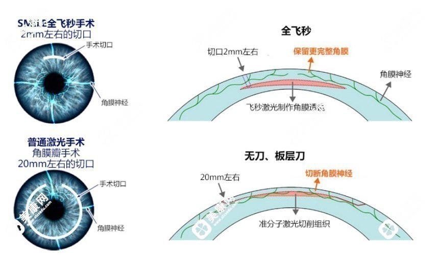 全飞秒和普通激光手术区别