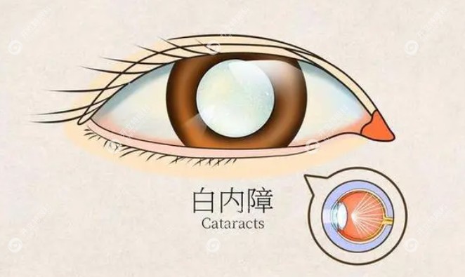 三焦点人工晶体适合人群