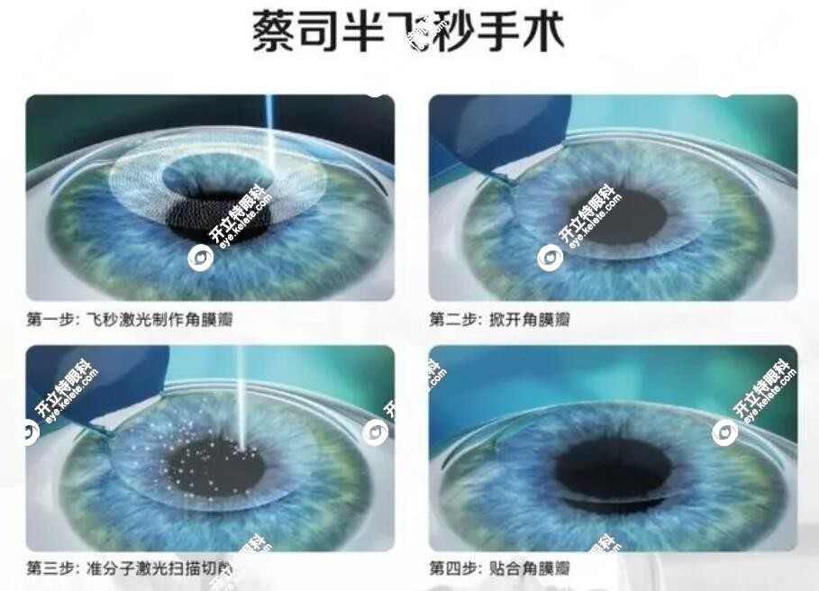 半飞秒近视手术价格：1万元起