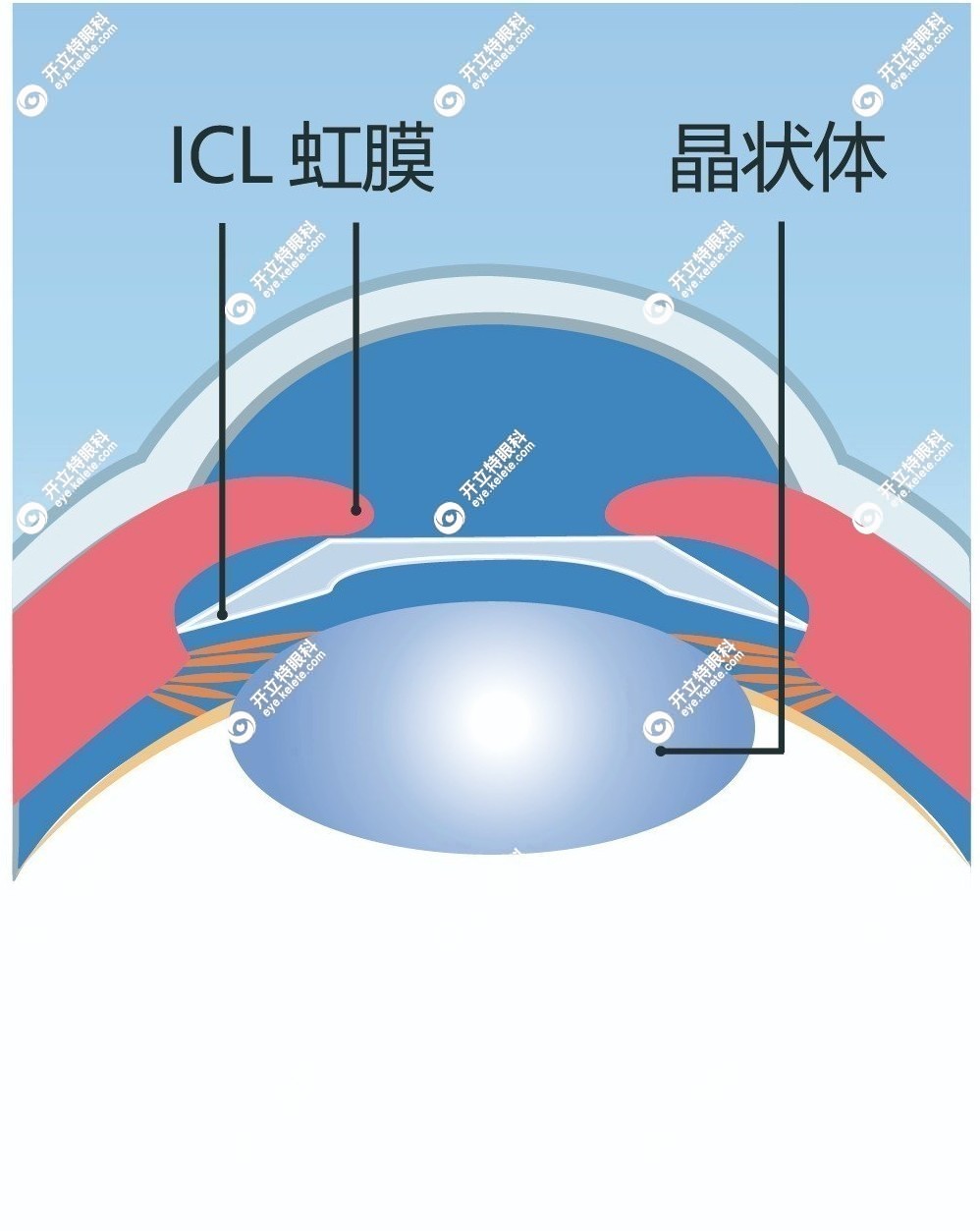 ICL晶体植入手术优势-视觉质量优异