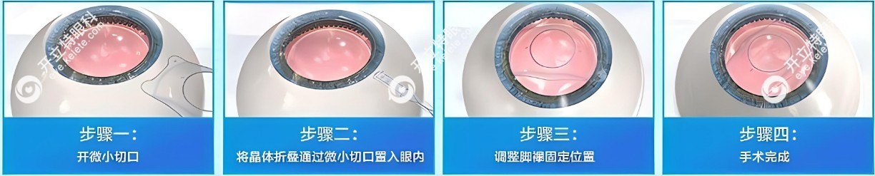 人工晶体植入手术过程