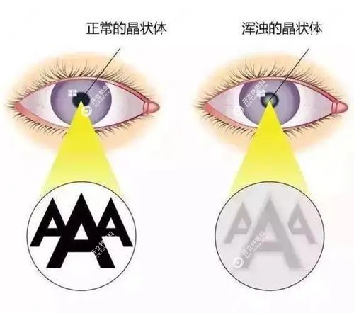 多焦点晶体植入和icl晶体植入的区别有术后视觉不同