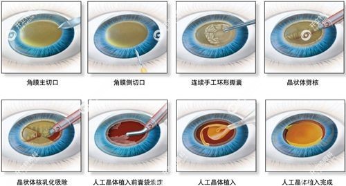 多焦点晶体植入和icl晶体植入的区别手术原理