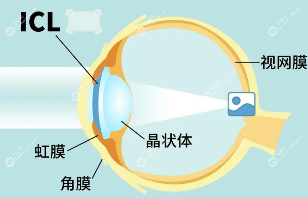 ICL晶体植入分两天做的好处www.fakemusicmedia.com