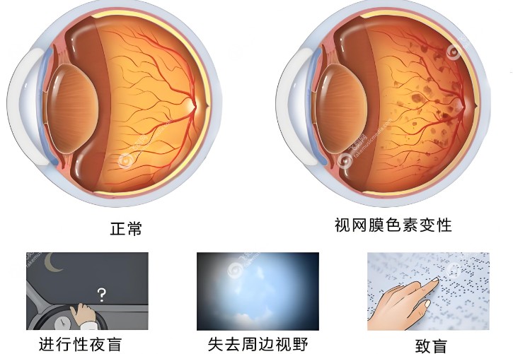 视网膜色素变性概述