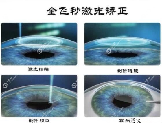 全飞秒激光近视手术过程