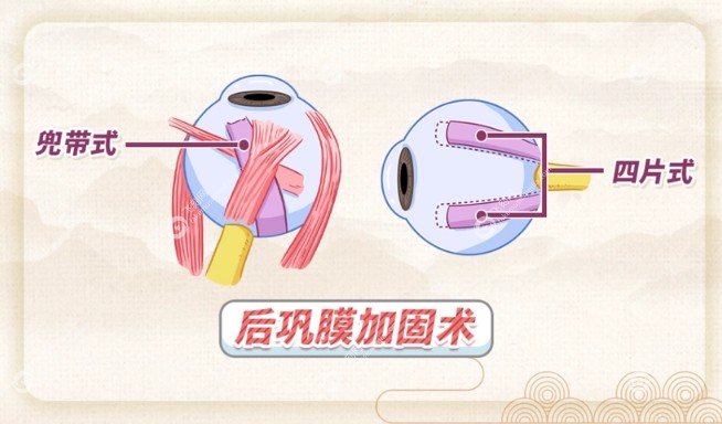 王乐今的微创后巩膜加固术怎么样
