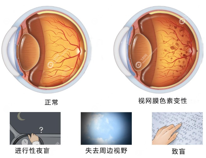 视网膜色素变性有救了