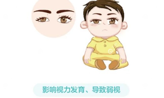 于刚医生做儿童上眼睑下垂技术好