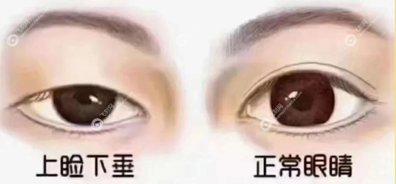 上睑下垂