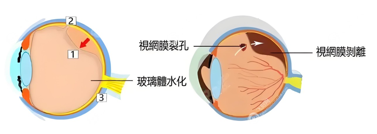 哪些人不能做后巩膜加固手术