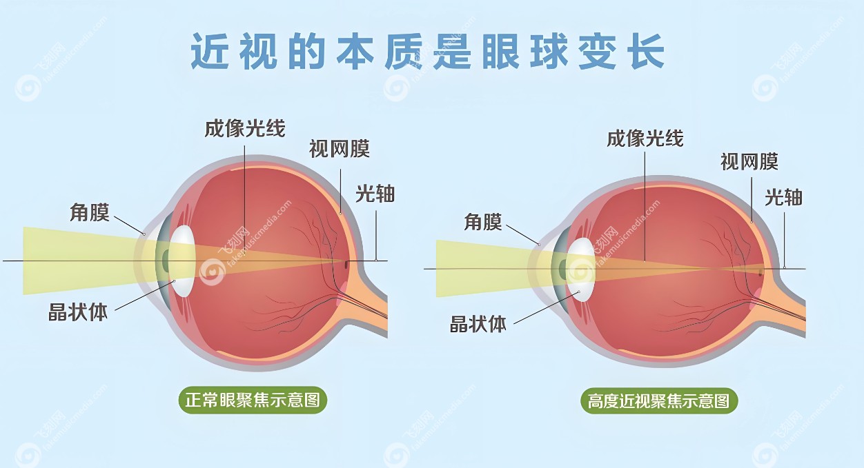 有必要做后巩膜加固手术