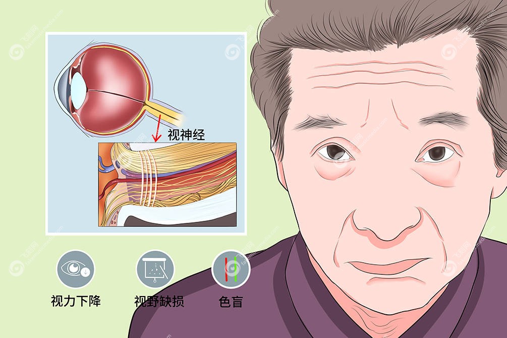 视神经萎缩失明有治好的先例吗