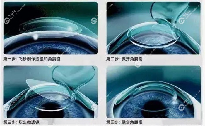 张勤眼科做半飞秒手术的原理图
