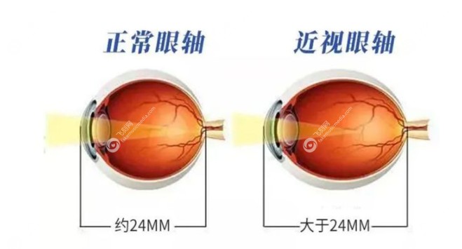 王乐今巩膜加固术眼轴控制的好