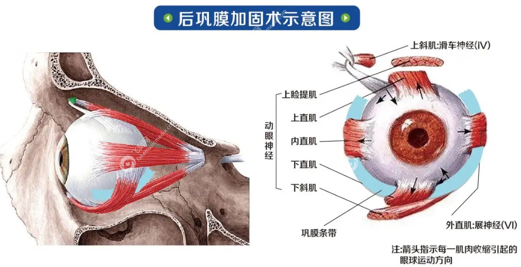 儿童做后巩膜加固术有效