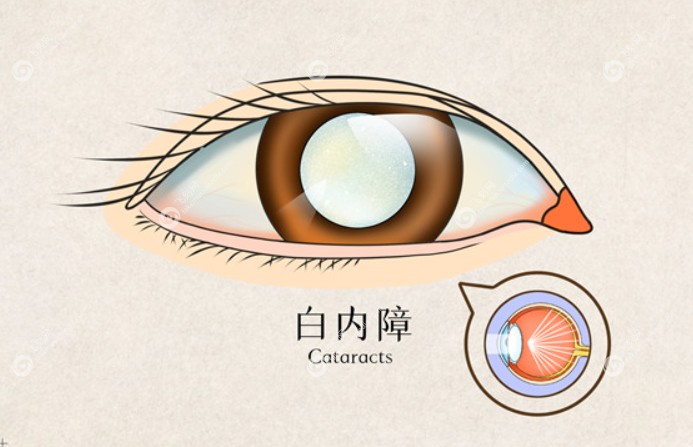 福州福清亮睛眼科白内障手术特点