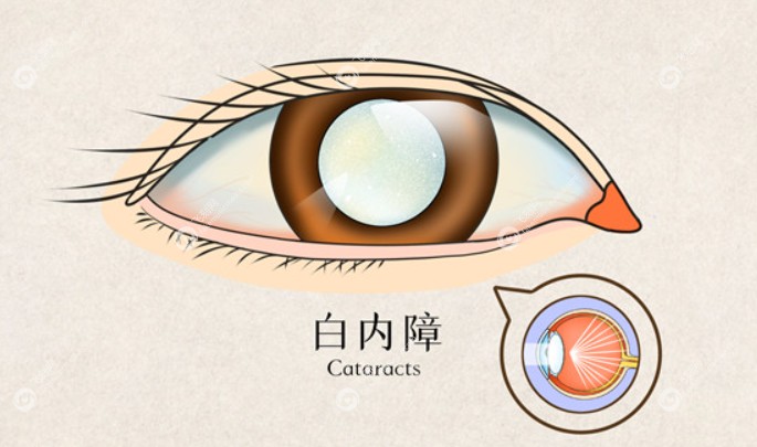 尖峰眼科刘保松白内障手术怎么样？