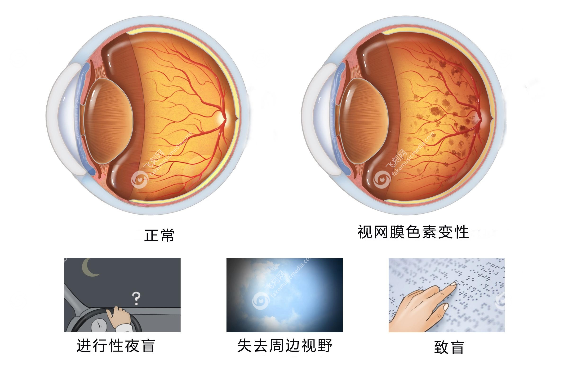 什么是视网膜色素变性