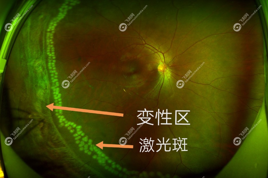 视网膜变性并非一辈子没事