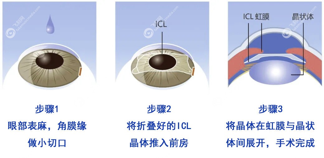 ICL晶体植入近视眼手术