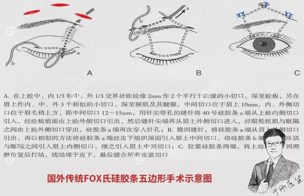 北京美和眼科于刚做儿童上眼睑下垂手术备受好评