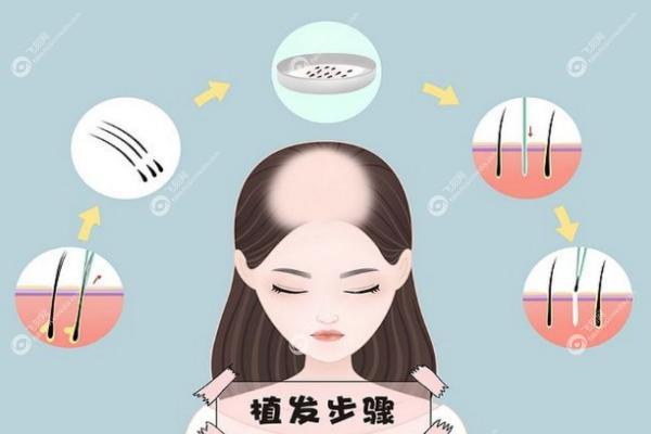 植发自己的毛囊不够可以用体毛吗