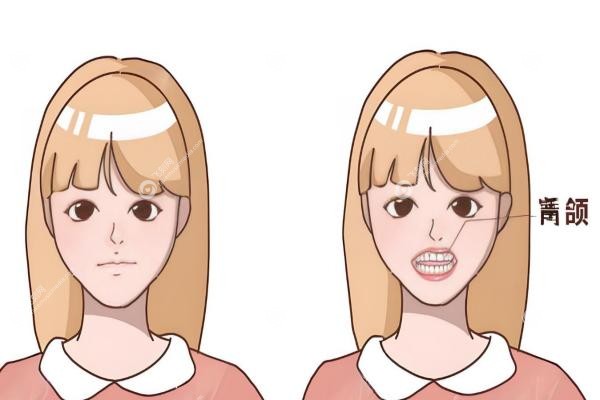 正颌手术风险大吗,过程是怎样的?哪些人必须做?一篇讲透所有疑惑!2