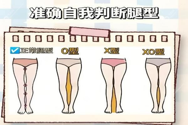 北京哪家医院可以做腿型矫正?北京腿型矫正医院排名前10!O/X型腿必看攻略!2