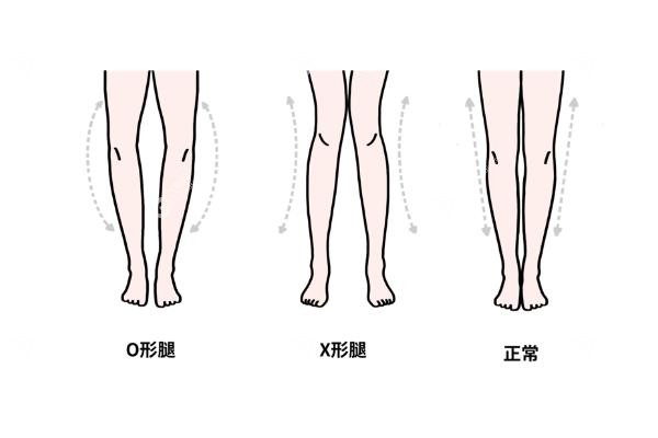 北京哪家医院可以做腿型矫正?北京腿型矫正医院排名前10!O/X型腿必看攻略!3