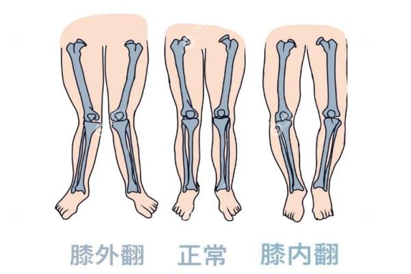 北京哪家医院可以做腿型矫正?北京腿型矫正医院排名前10!O/X型腿必看攻略!