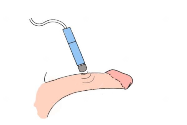 生物补片增粗效.jpg