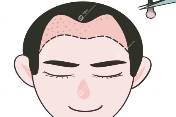 珠海碧莲盛植发怎么样