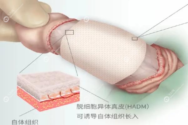 生物补片增大增粗术一年后患者留言.jpg
