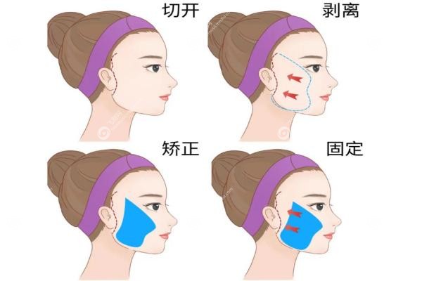 成都筋膜提升好医生推荐
