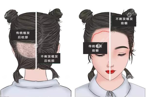 昆明植发医院排名前五