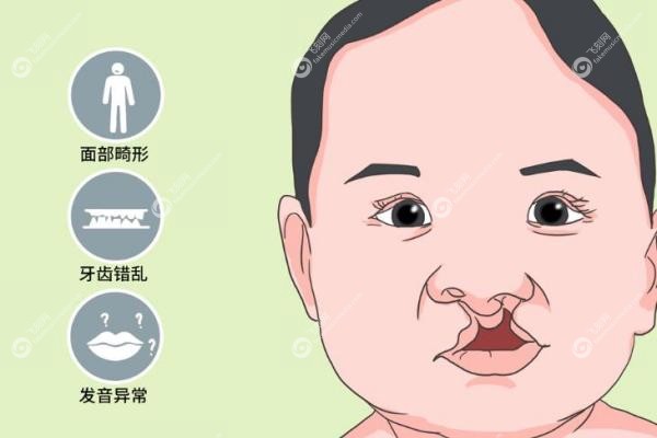 余文林唇裂修复怎么样.jpg