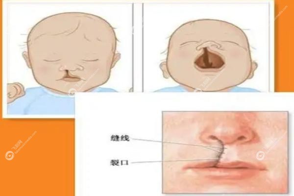 余文林唇裂修复怎么样.jpg