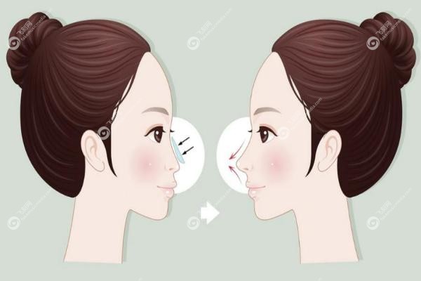 南京曹海峰鼻修复怎么样?修复技术3大优势盘点,附真实案 例+坐诊医院3