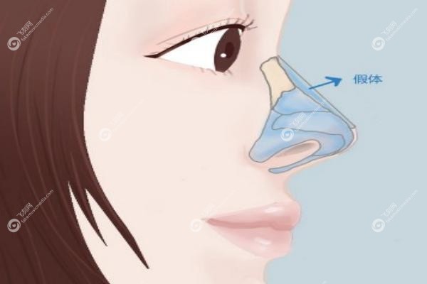 欧阳春医生鼻整形实例