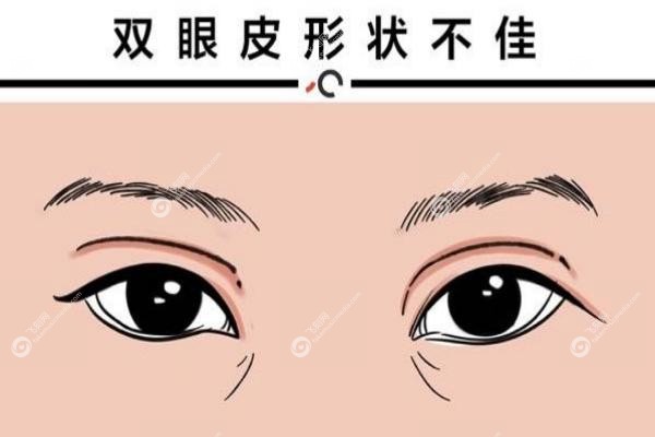 郑州黄军伟双眼皮<span style=