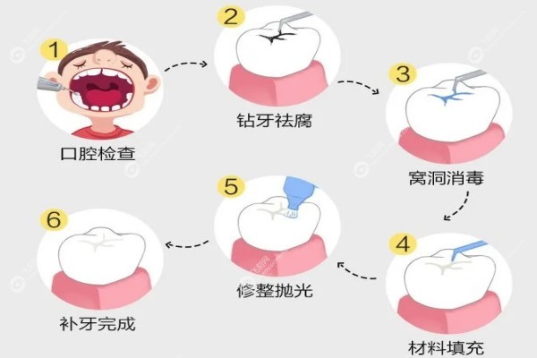 补牙多少钱一颗牙价格表3.jpg