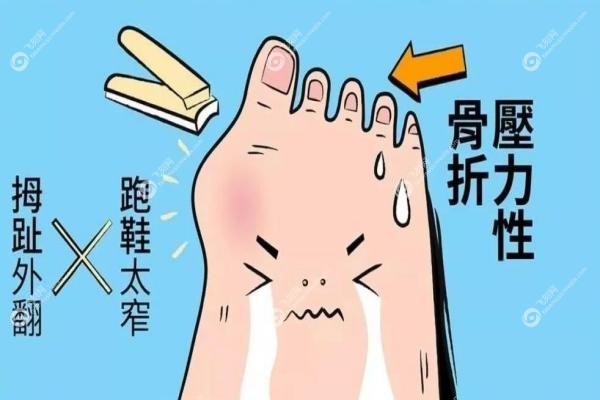 苏敬达做大脚骨手术技术水平咋样?3毫米切口当天走路,附口碑+医院地址3