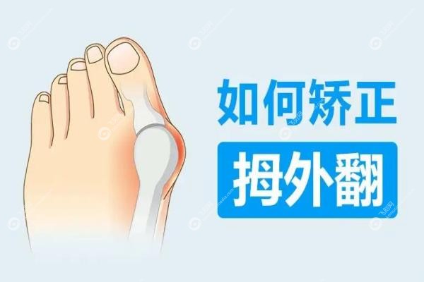 苏敬达做大脚骨手术技术水平咋样?3毫米切口当天走路,附口碑+医院地址