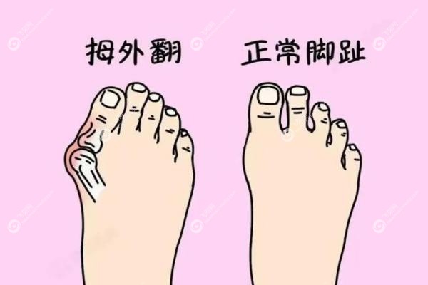 苏敬达做大脚骨手术技术水平咋样?3毫米切口当天走路,附口碑+医院地址2