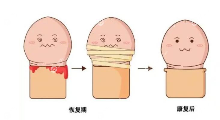 长沙爱思特医院做包皮环切怎么样 