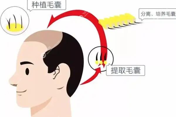 碧莲盛植发价格一览表