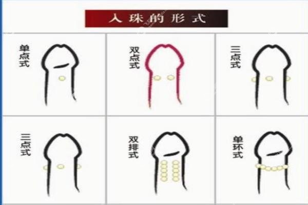 男士入珠手术价格表.jpg