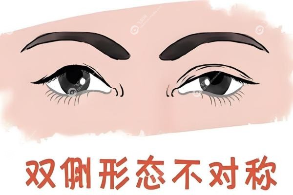 常冬青修复双眼皮怎么样?毫米级修复术